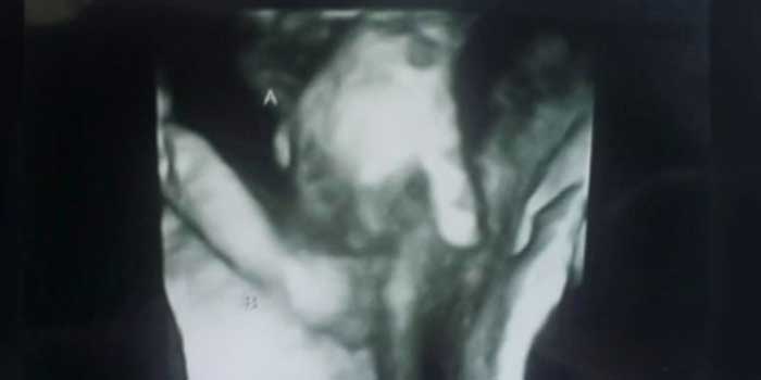 The sonogram showing the twins holding hands